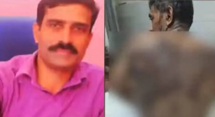 വീട്ടിലെത്തിയ സഹോദരന്റെ സുഹൃത്തിന് നേരെ ആസിഡ് ആക്രമണം ; പ്രതി പിടിയിൽ വീട്ടിലെത്തിയ സഹോദരന്റെ സുഹൃത്തിന് നേരെ ആസിഡ് ആക്രമണം ; പ്രതി പിടിയിൽ