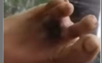 ഡോക്ടറുടെ അനാസ്ഥ ; യുവാവിന്റെ കാല് വിരല് മുറിച്ചു മാറ്റേണ്ടി വന്നതായി പരാതി