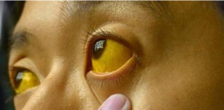 മലപ്പുറം വണ്ടൂരിൽ ഹോട്ടലിൽനിന്ന് മഞ്ഞപ്പിത്തബാധ ; ഒരാൾ മരിച്ചു, നൂറിലേറെ പേർക്ക് രോഗം സ്ഥിരീകരിച്ചു